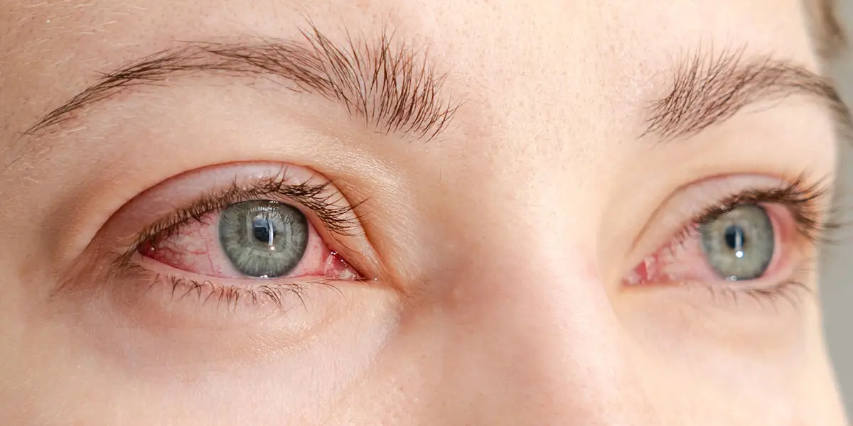 What Do Heroin Eyes Look Like? Signs, Symptoms, and Long-Term Effects